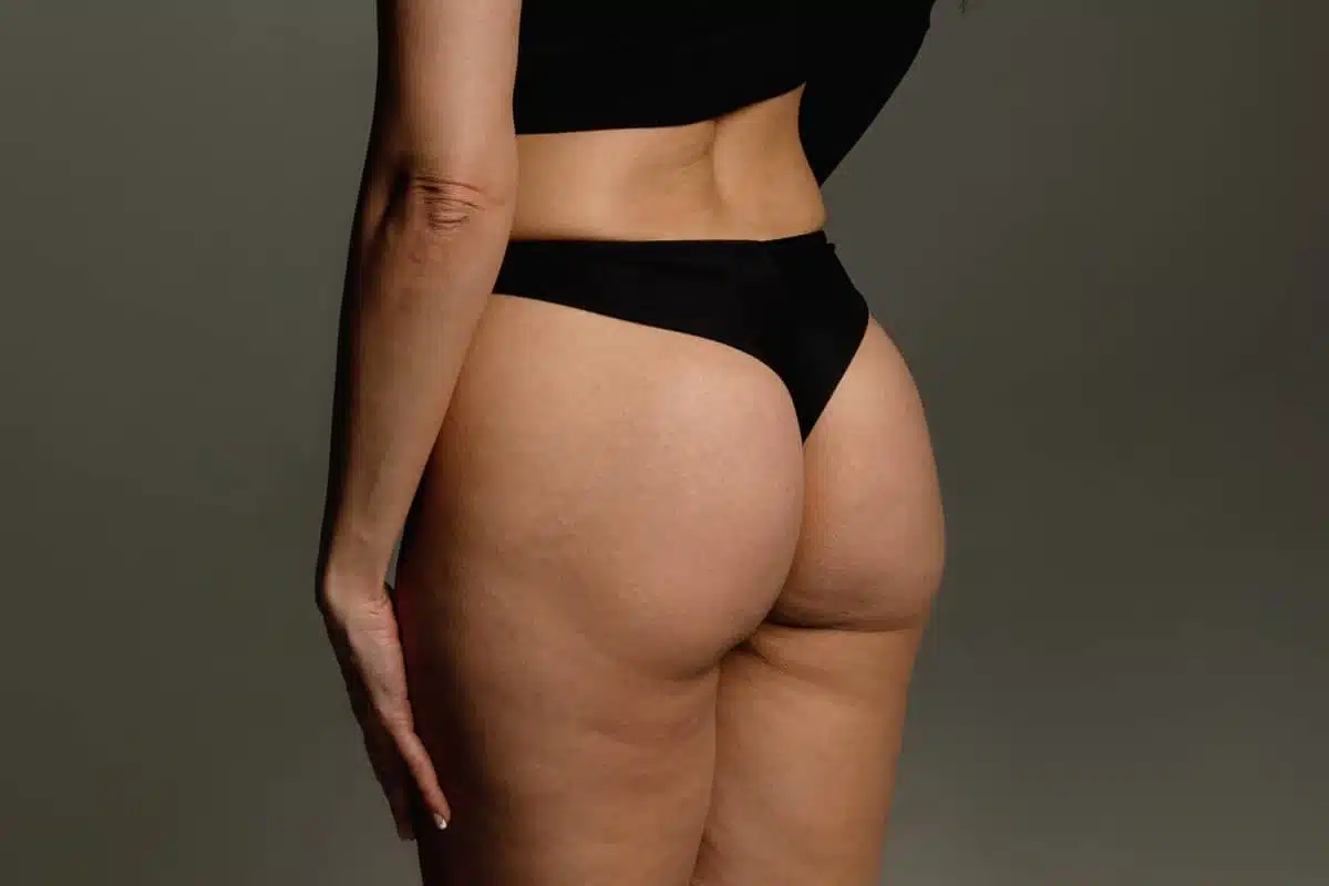 la-liposuccion-est-elle-une-solution-a-la-cellulite-dr-favre.jpg